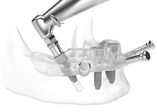 GUIDED DENTAL IMPLANTS IN CHENNAI